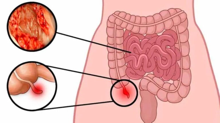 Why appendix cancer is rising among the young & how it differs from colon cancer – Firstpost